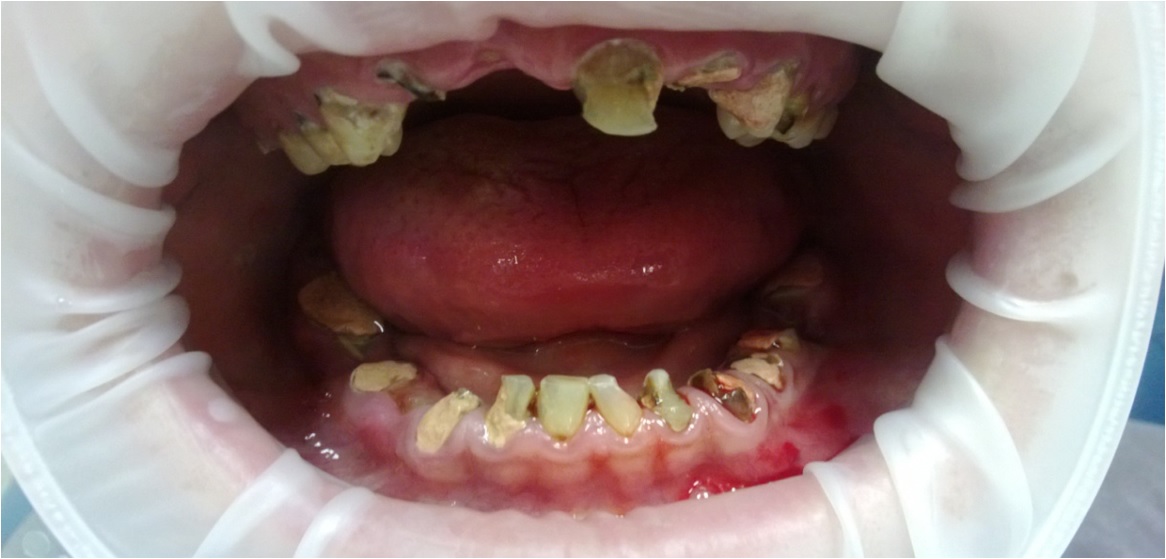 Протезирование передних зубов – фото 5
