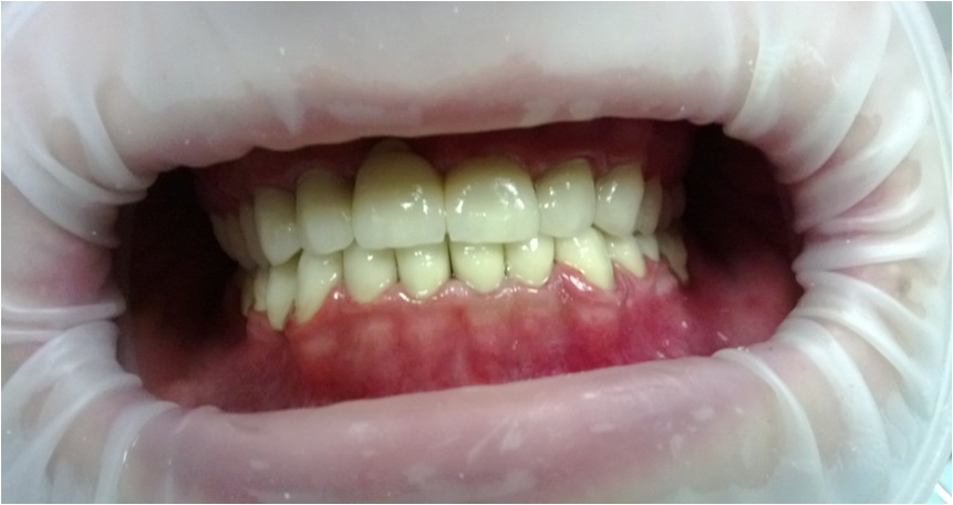 Протезирование передних зубов – фото 6
