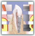 Имплантация зубов - наиболее прогрессивный метод лечения в стоматологии – фото 2