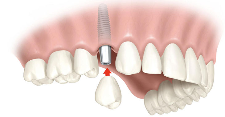 Классическая имплантация зубов – фото 1