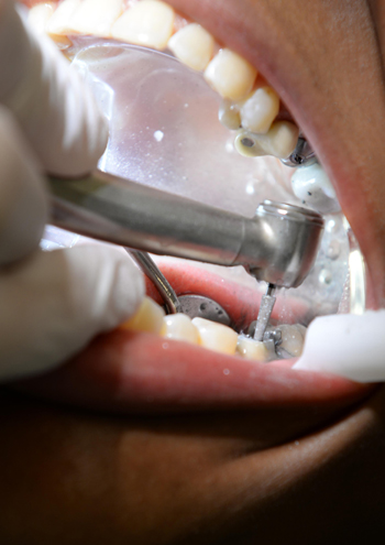 Эндодонтическое лечение зубов – фото 1