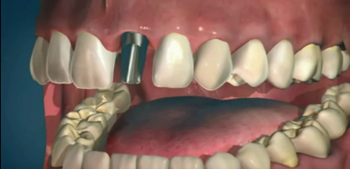 Экспресс имплантация зубов – фото 3