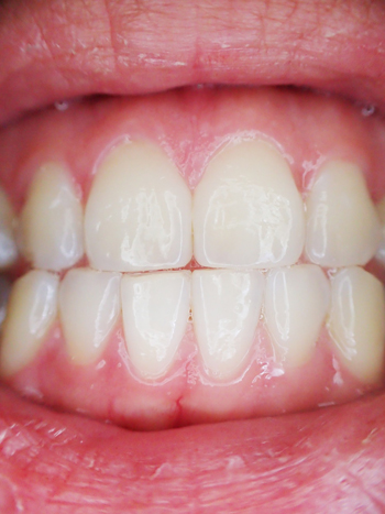 Экспресс имплантация зубов – фото 4