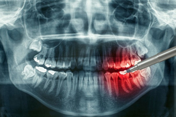 Классическая имплантация зубов – фото 2