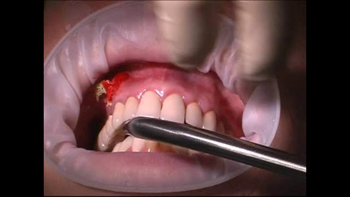 Классическая имплантация зубов – фото 3