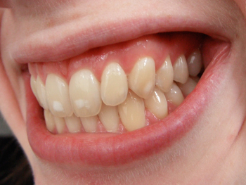 Классическая имплантация зубов – фото 4