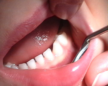 Классическая имплантация зубов – фото 5
