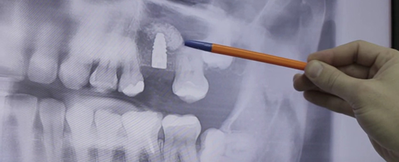 Имплантация зубов под ключ – фото 2