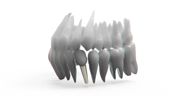 Полная комплексная имплантация зубов – фото 2