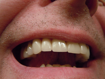 Протезирование после удаления зуба – фото 2