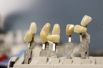 Имплантация зубов  – фото 3