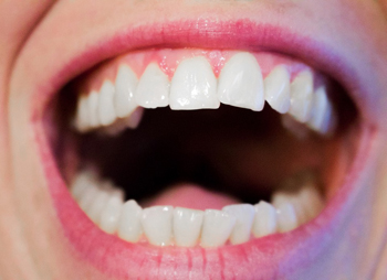 Имплантация верхних зубов – фото 1