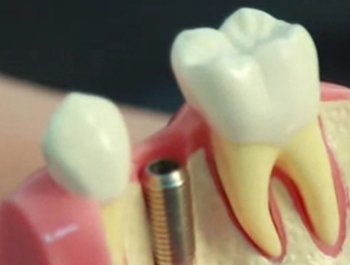 Имплантация верхних зубов – фото 2