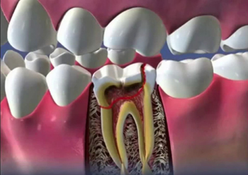 Лечение периодонтита зубов – фото 5