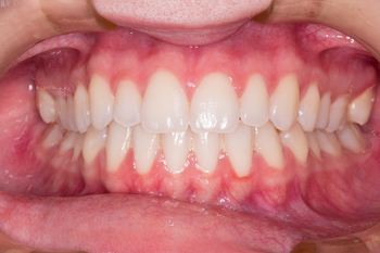 Отбеливание зубов по технологии zoom 3 – фото 1