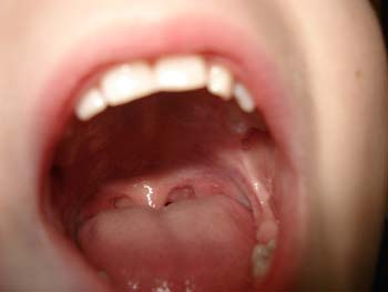 Синус-лифтинг: использование при имплантации зубов – фото 3