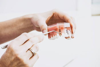 Системы имплантации зубов – фото 1