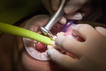 Системы имплантации зубов – фото 5