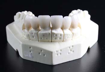 Сколько стоит вставить передний зуб? – фото 1