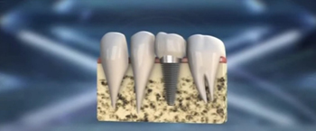 Виды и цены имплантации зубов – фото 2