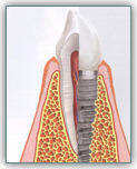 Имплантация зубов - наиболее прогрессивный метод лечения в стоматологии – фото 1