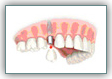 Имплантация зубов - наиболее прогрессивный метод лечения в стоматологии – фото 4