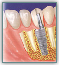 Имплантация зубов - наиболее прогрессивный метод лечения в стоматологии – фото 5