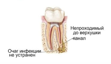 Лечение периодонтита зубов – фото 3