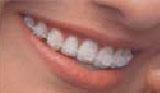 Ортодонтические пластинки – фото 1
