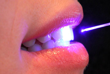 Лазерная стоматология – фото 3