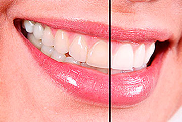 Лазерное отбеливание зубов – фото 3