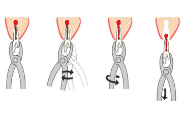 Удаление зубов в стоматологии Медикастом  – фото 1