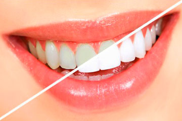 Гигиеническая чистка зубов – фото 3