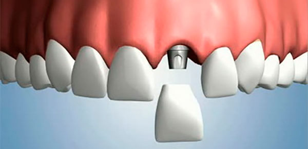 Протезирование после удаления зуба – фото 1