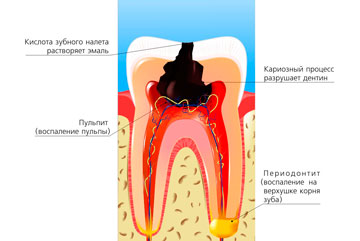 Лечение пульпита зуба – фото 1