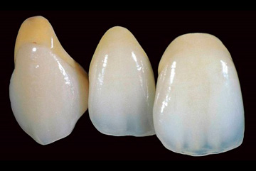 Коронки на передние зубы – фото 4