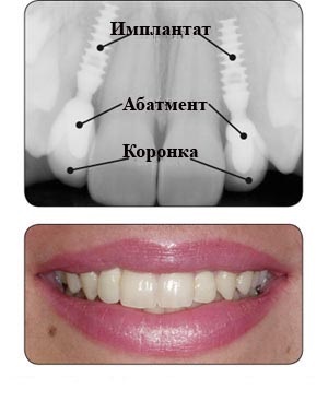Имплантация зубов Bicon – фото 3