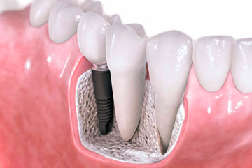 Вставить зубные импланты в клинике Медикастом – фото 1