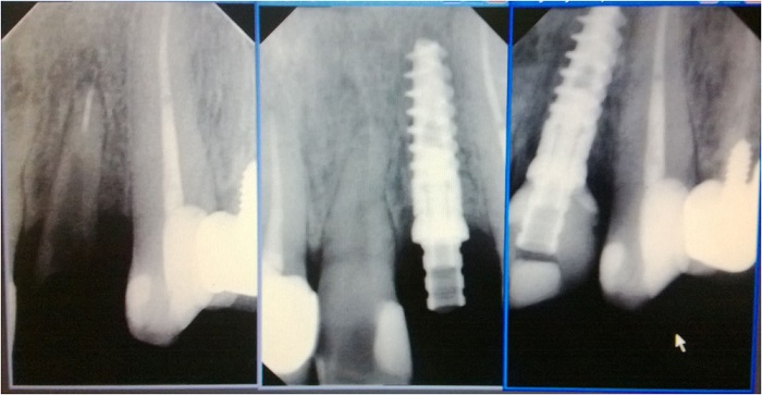 Вставить зубные импланты в клинике Медикастом – фото 2