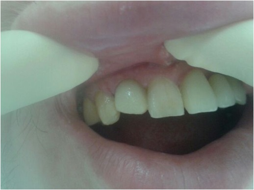 Вставить зубные импланты в клинике Медикастом – фото 4