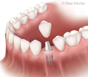 
Преимущества имплантации зубов  – фото 1