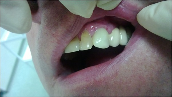Имплантация передних зубов – фото 1