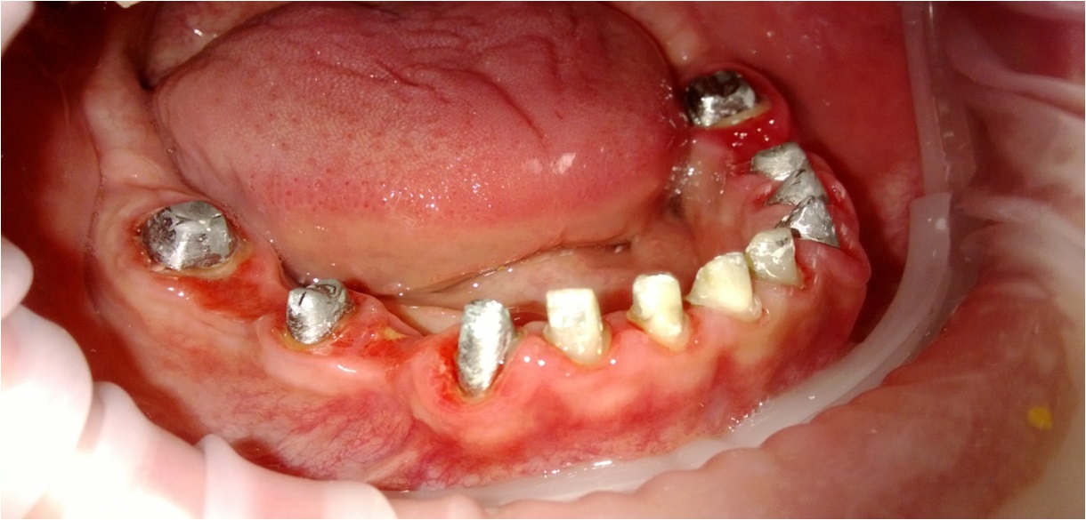 Протезирование передних зубов – фото 4