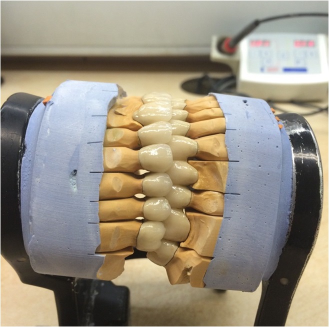 Протезирование передних зубов – фото 3