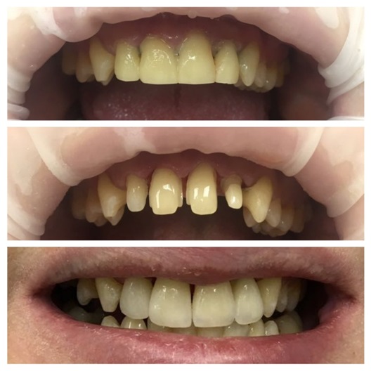 Протезирование передних зубов – фото 7